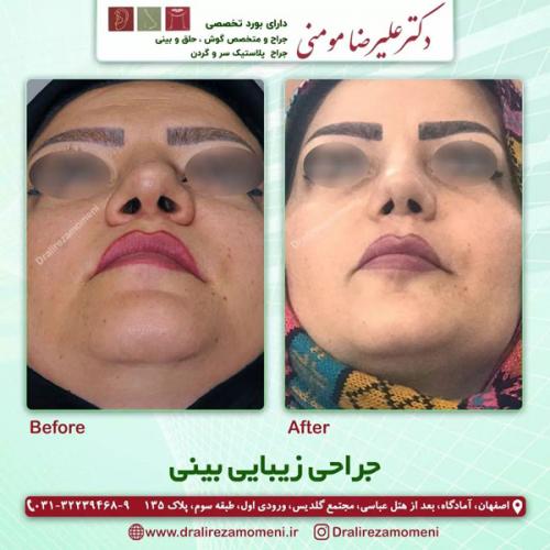 جراحی-بینی-354