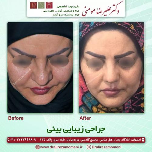 جراحی-بینی-355