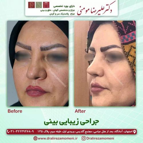 جراحی-بینی-356