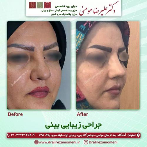 جراحی-بینی-357