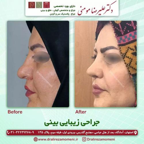 جراحی-بینی-358