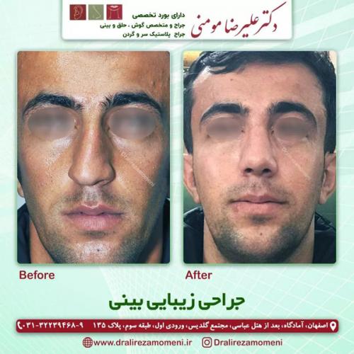 جراحی-بینی-360