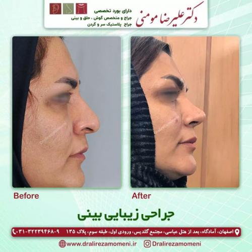 جراحی-بینی-381