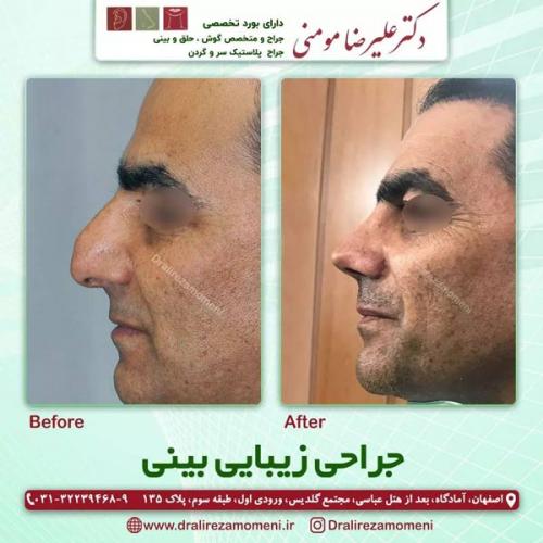 جراحی-بینی-399