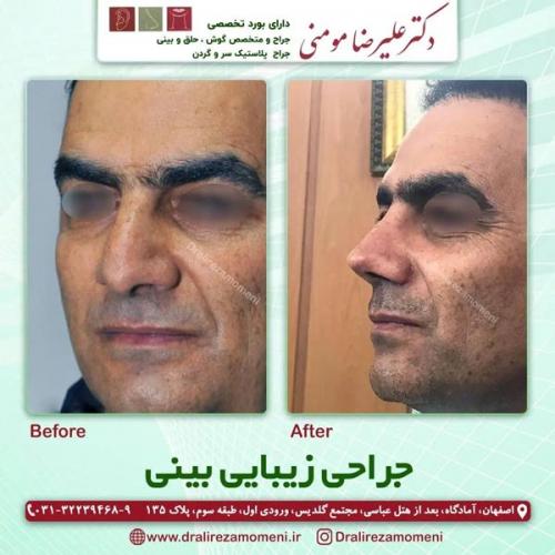 جراحی-بینی-401