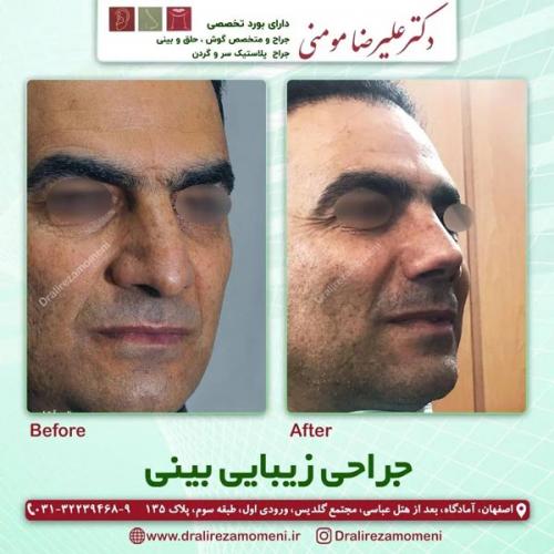 جراحی-بینی-402