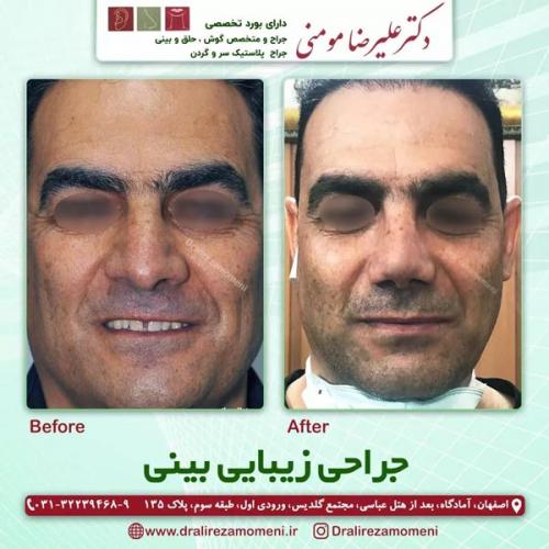 جراحی-بینی-403