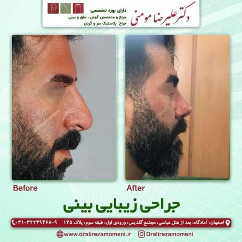 جراحی-بینی-406