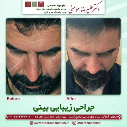 جراحی-بینی-408