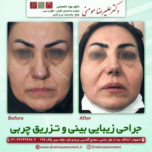 جراحی-بینی-410