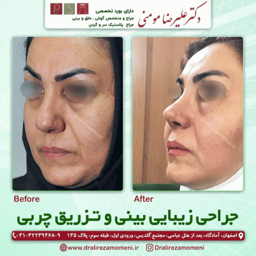 جراحی-بینی-412
