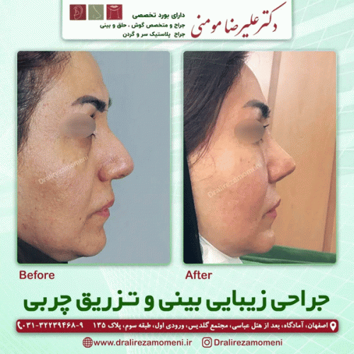 جراحی-بینی-415
