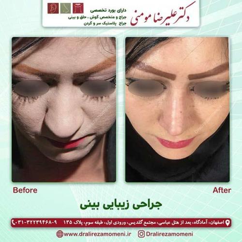 جراحی-بینی-42