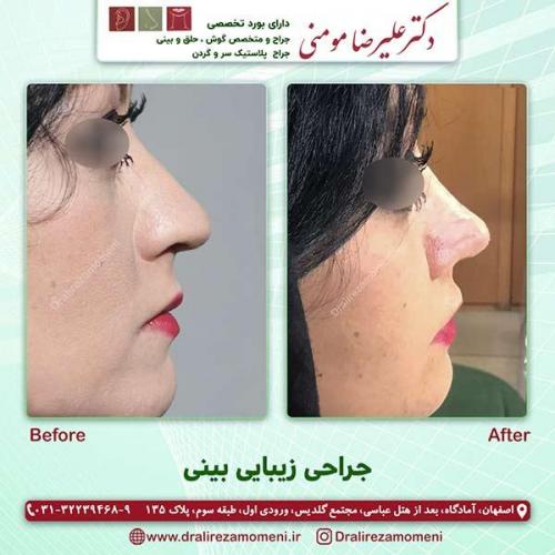 جراحی-بینی-45
