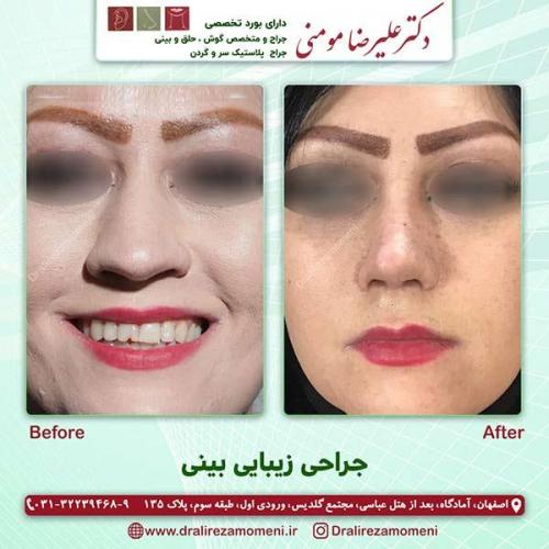 جراحی-بینی-46