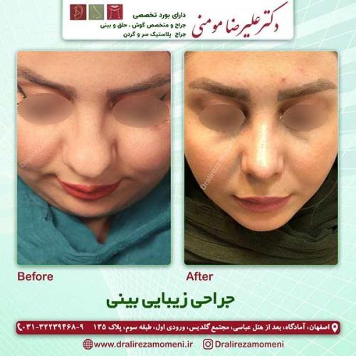 جراحی-بینی-5