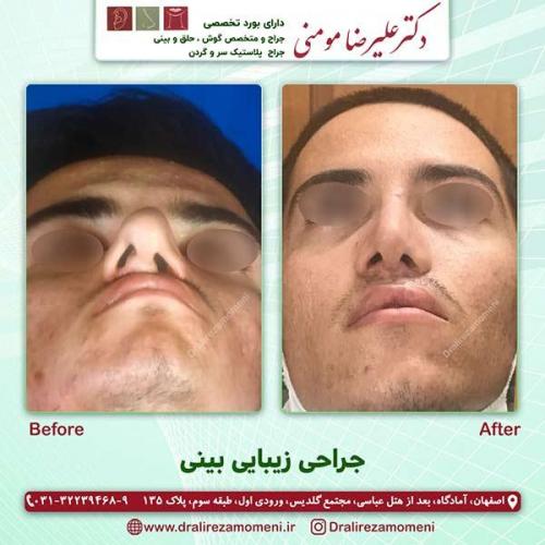 جراحی-بینی-53