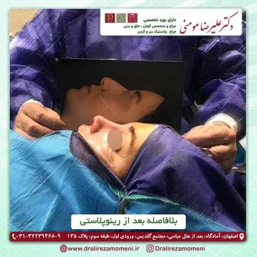 جراحی-بینی-56