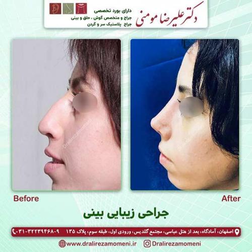 جراحی-بینی-57