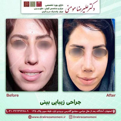 جراحی-بینی-58