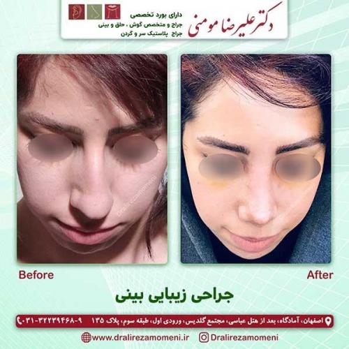 جراحی-بینی-60