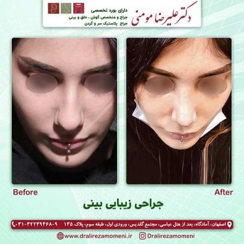 جراحی-بینی-68