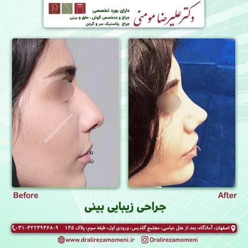 جراحی-بینی-69