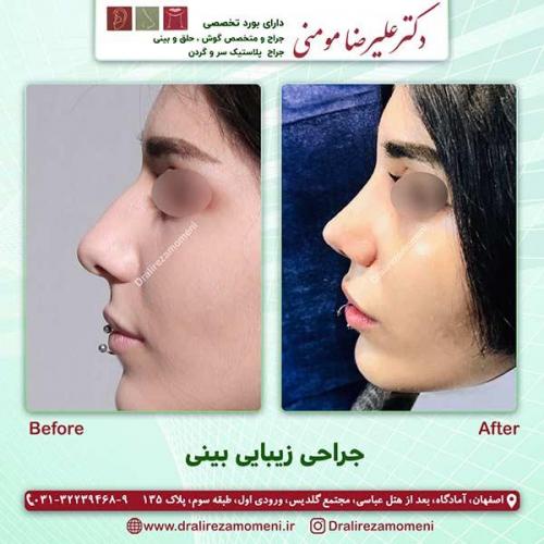 جراحی-بینی-70