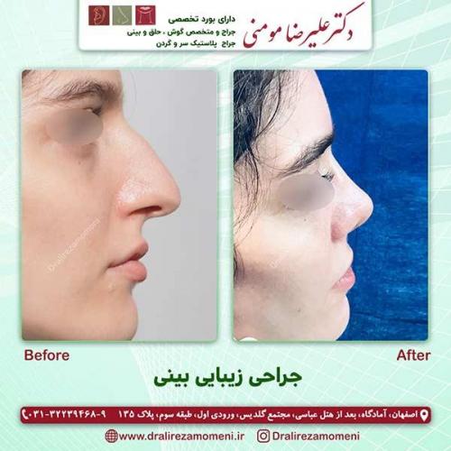 جراحی-بینی-72