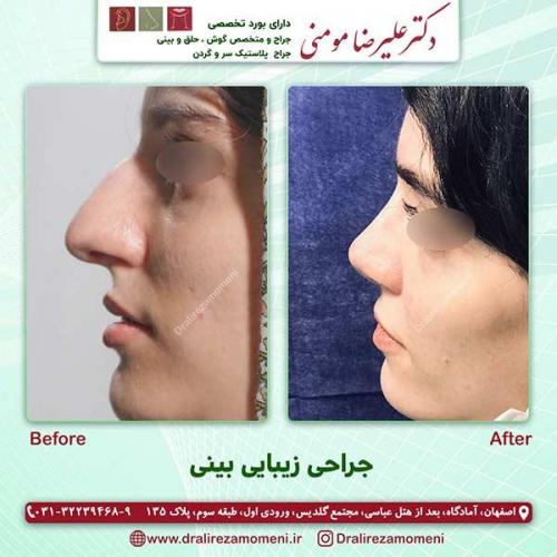 جراحی-بینی-73