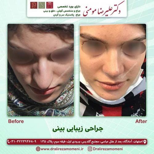 جراحی-بینی-75