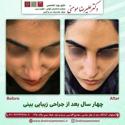 جراحی-بینی-82