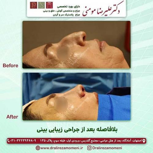 جراحی-بینی-85