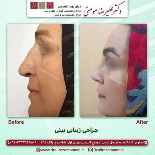 جراحی-بینی-91