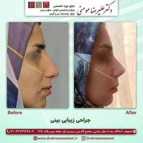جراحی-بینی-95