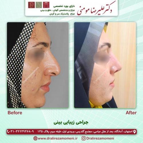 جراحی بینی 173