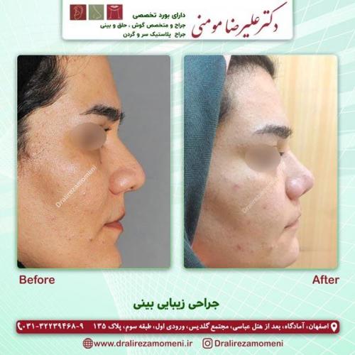 جراحی بینی 175