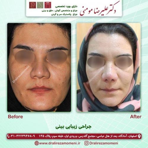 جراحی بینی 176