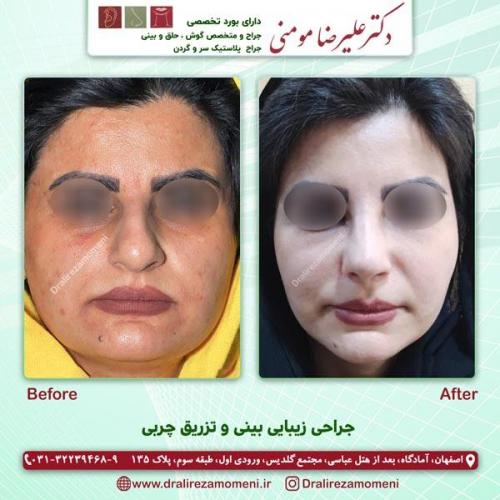 جراحی بینی 177