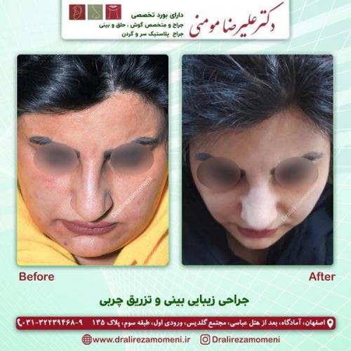 جراحی بینی 179