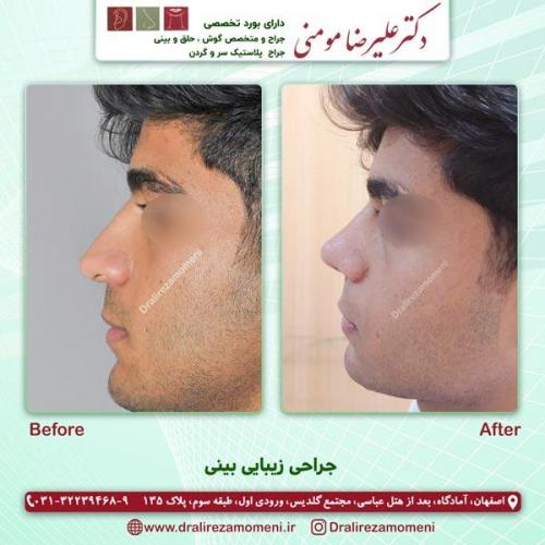 جراحی بینی 181