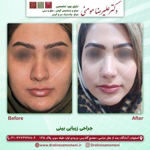 جراحی بینی 182