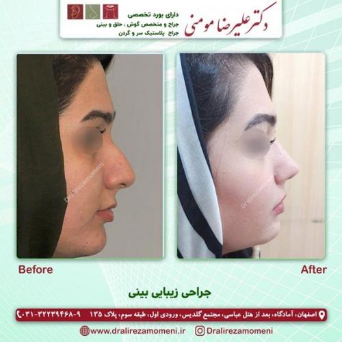 جراحی بینی 183