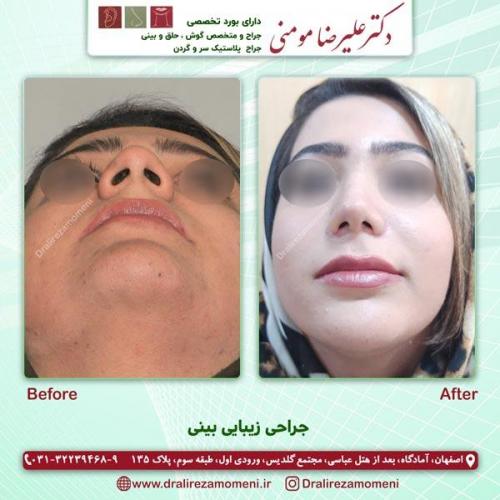 جراحی بینی 184