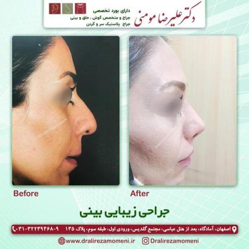 جراحی بینی 185