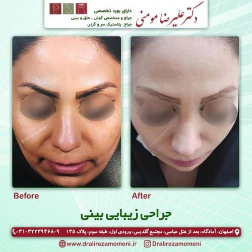 جراحی بینی 186
