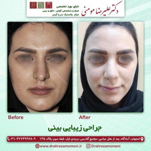 جراحی بینی 188