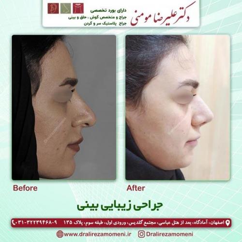 جراحی بینی 189