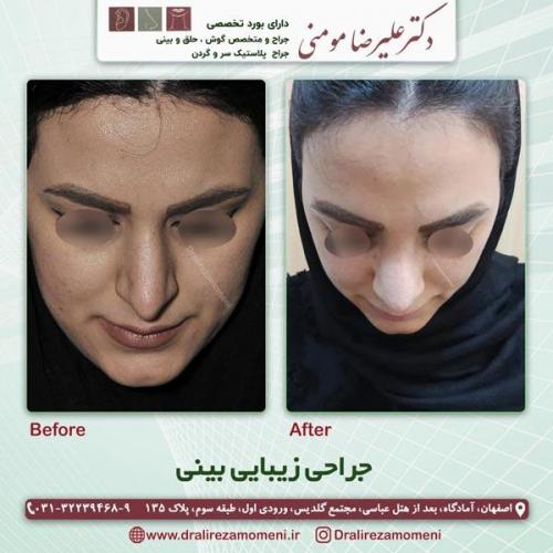 جراحی بینی 190